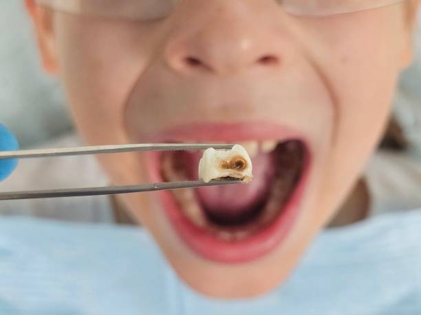 Best Cracked Tooth Emergency Dentist  in Cornelia, GA
