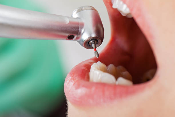 Best Root Canal Emergency Dentist  in Cornelia, GA